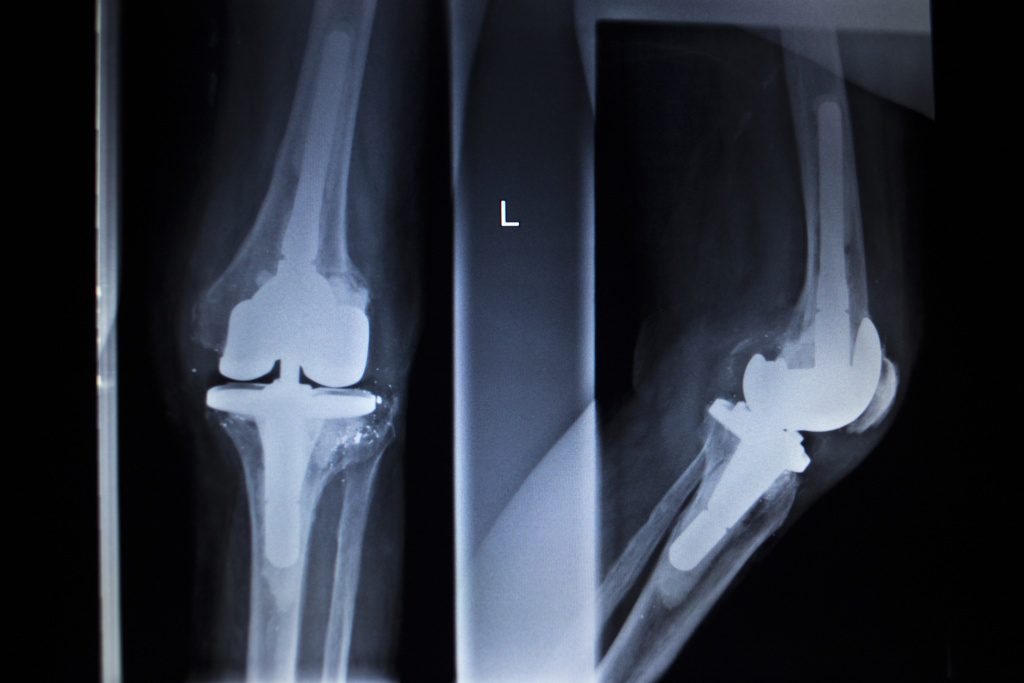 X-ray orthopedic medical CAT scan of painful knee meniscus injury leg in Traumatology hospital clinic with prosthetics Trauma implant.